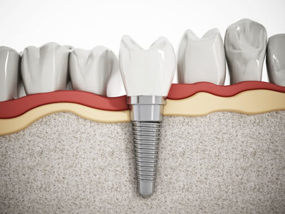 Are You Looking For Mini Dental Implants Near Playa Vista?