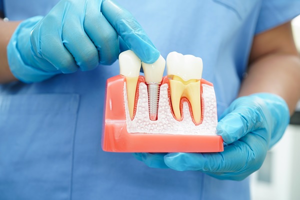 Implant Dentistry: The Single Tooth Replacement Process